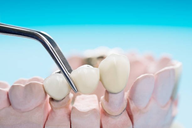 Dental-Crowns-and-Bridges-1